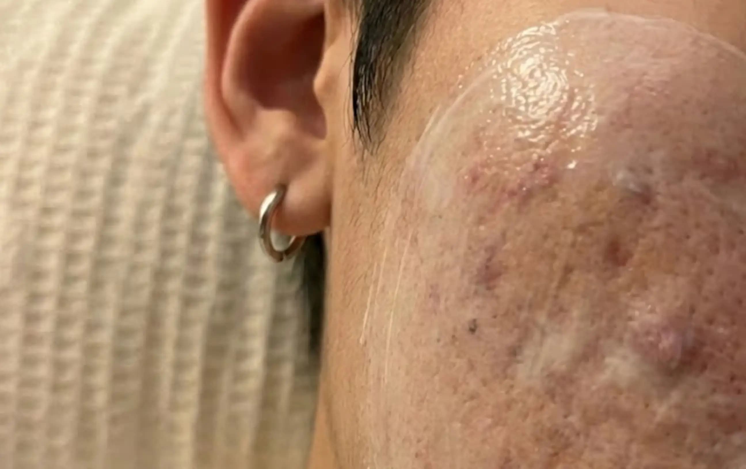 アジダームクリーム 20% 15g入り（ニキビ治療薬スキノレンクリームのジェネリック医薬品）のレビュー画像