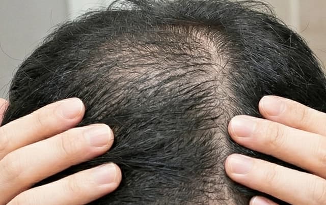 ツゲイン 2%・5%・10% 60ml入り(ミノキシジル外用薬)のレビュー画像